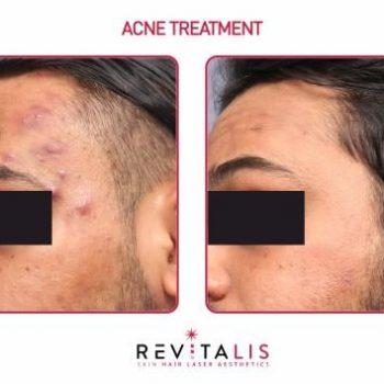 ACNE TREATMENT 1 - REVITALIS Skin and Hair Clinic
