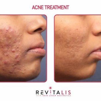 ACNE TREATMENT 1 - REVITALIS Skin and Hair Clinic