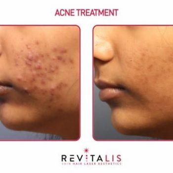 ACNE TREATMENT 1 - REVITALIS Skin and Hair Clinic