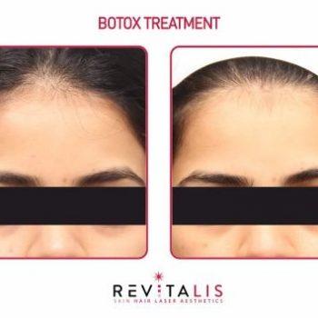 BOTOX TREATMENT - REVITALIS Skin and Hair Clinic