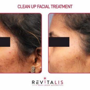 CLEAN UP FACIAL TREATMENT - REVITALIS Skin and Hair Clinic
