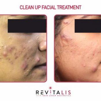CLEAN UP FACIAL TREATMENT - REVITALIS Skin and Hair Clinic