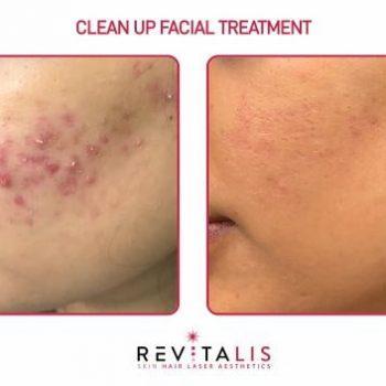CLEAN UP FACIAL TREATMENT - REVITALIS Skin and Hair Clinic