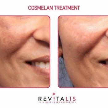 COSMELAN TREATMENT - REVITALIS Skin and Hair Clinic (3)