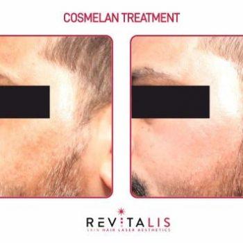 COSMELAN TREATMENT - REVITALIS Skin and Hair Clinic (3)