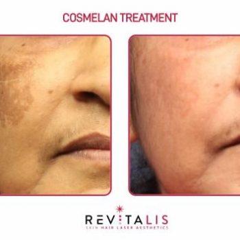 COSMELAN TREATMENT - REVITALIS Skin and Hair Clinic (3)
