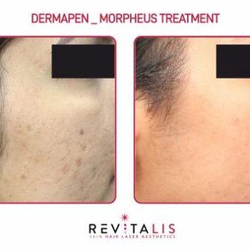 DERMAPEN _ MORPHEUS TREATMENT - REVITALIS Skin and Hair Clinic