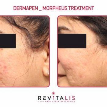 DERMAPEN _ MORPHEUS TREATMENT - REVITALIS Skin and Hair Clinic
