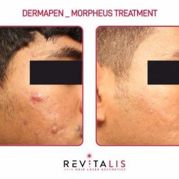 DERMAPEN _ MORPHEUS TREATMENT - REVITALIS Skin and Hair Clinic