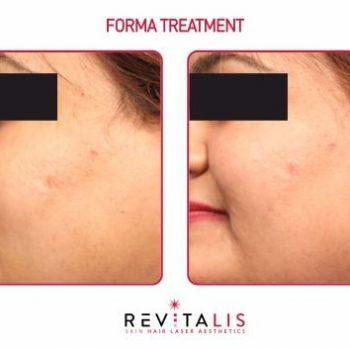 FORMA TREATMENT - REVITALIS Skin and Hair Clinic