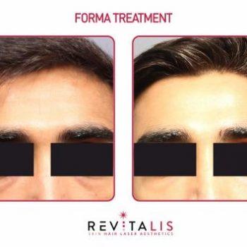 FORMA TREATMENT - REVITALIS Skin and Hair Clinic