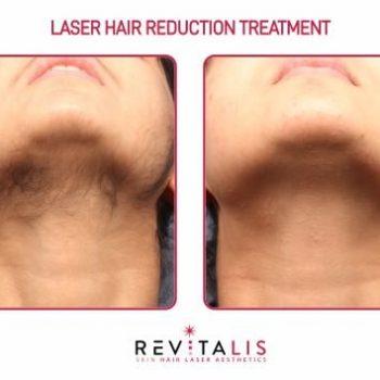 LASER HAIR REDUCTION TREATMENT - REVITALIS Skin and Hair Clinic