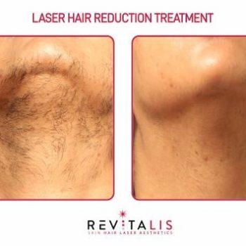 LASER HAIR REDUCTION TREATMENT - REVITALIS Skin and Hair Clinic