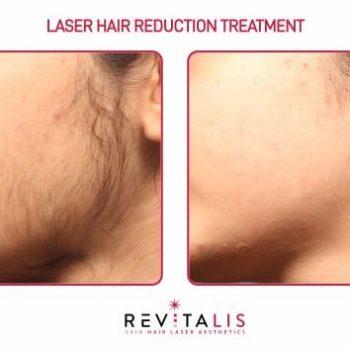 LASER HAIR REDUCTION TREATMENT - REVITALIS Skin and Hair Clinic
