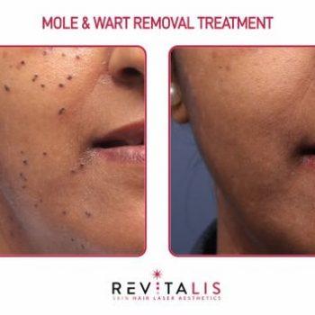 MOLE & WART REMOVAL TREATMENT - REVITALIS Skin and Hair Clinic