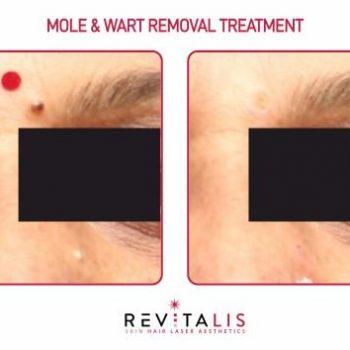 MOLE & WART REMOVAL TREATMENT - REVITALIS Skin and Hair Clinic