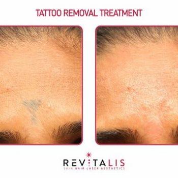 TATTOO REMOVAL TREATMENT - REVITALIS Skin and Hair Clinic