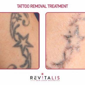 TATTOO REMOVAL TREATMENT - REVITALIS Skin and Hair Clinic