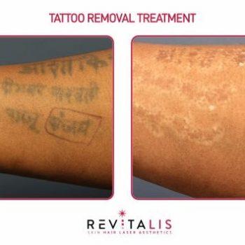TATTOO REMOVAL TREATMENT - REVITALIS Skin and Hair Clinic