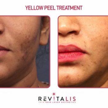 YELLOW PEEL TREATMENT - REVITALIS Skin and Hair Clinic