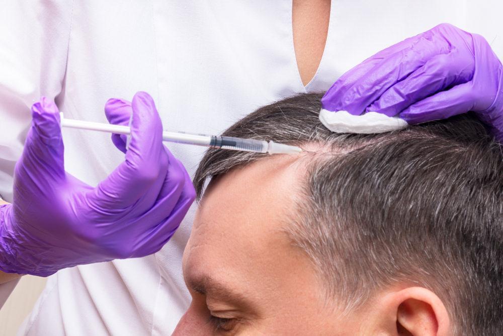 Worried Over Excessive Hair Loss? Resort To PRP Hair Restoration - Revitalis
