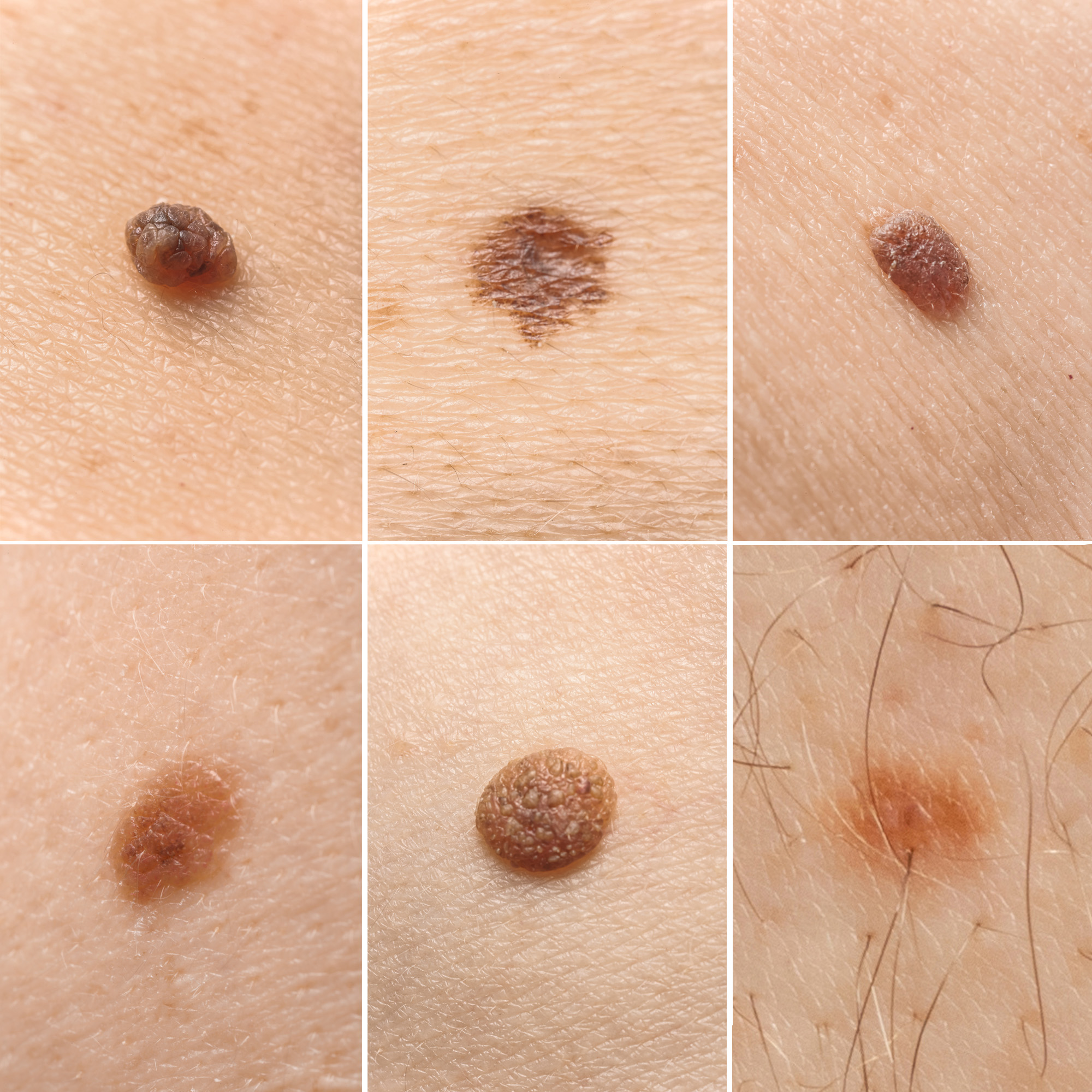 Understanding Different Types Of Moles Revitalis