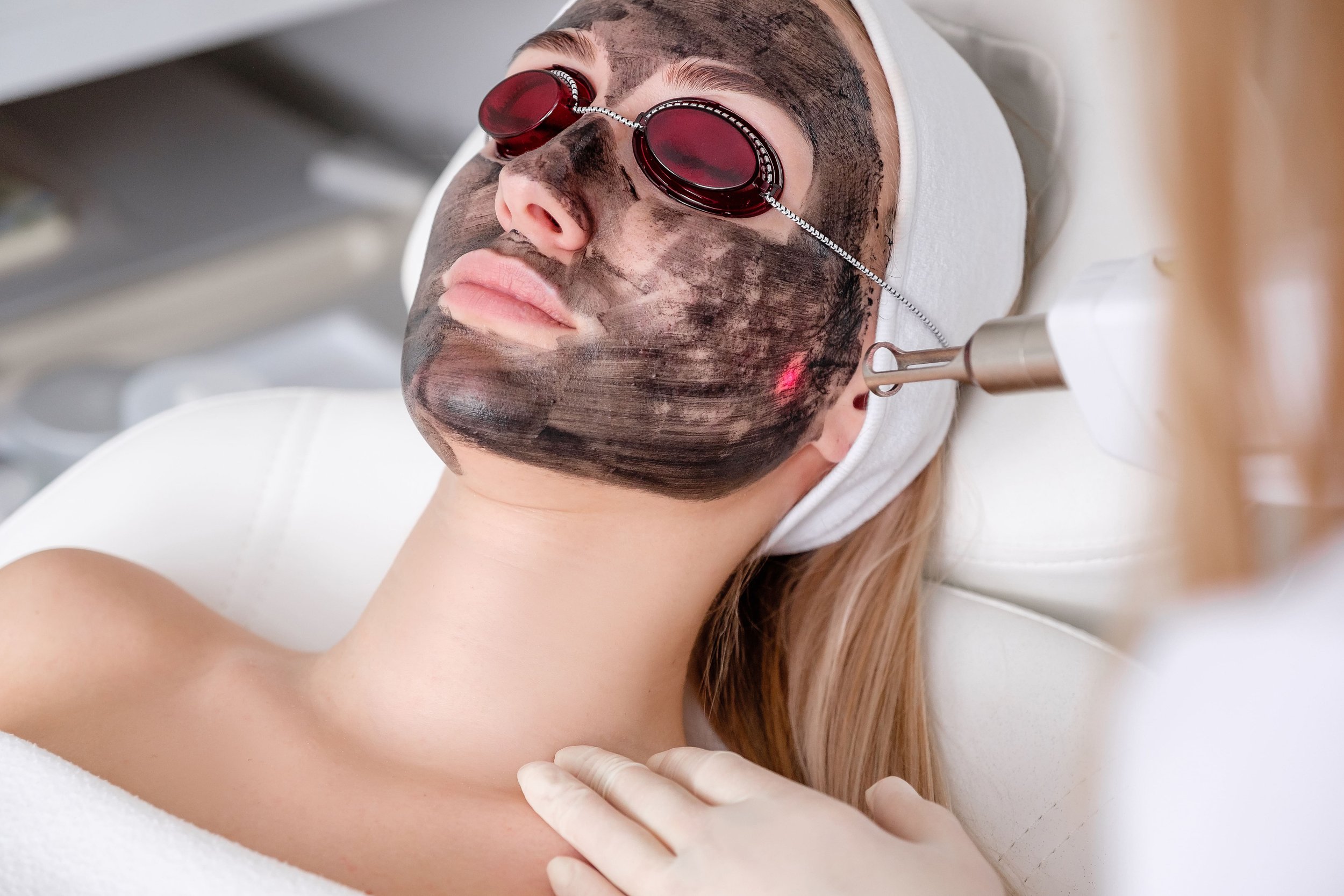 Carbon Peel