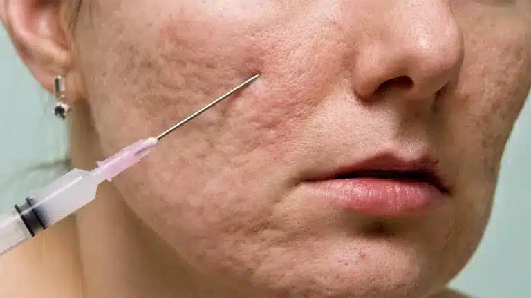 Subcision Therapy