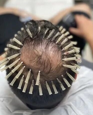 PDO Scalp Threads