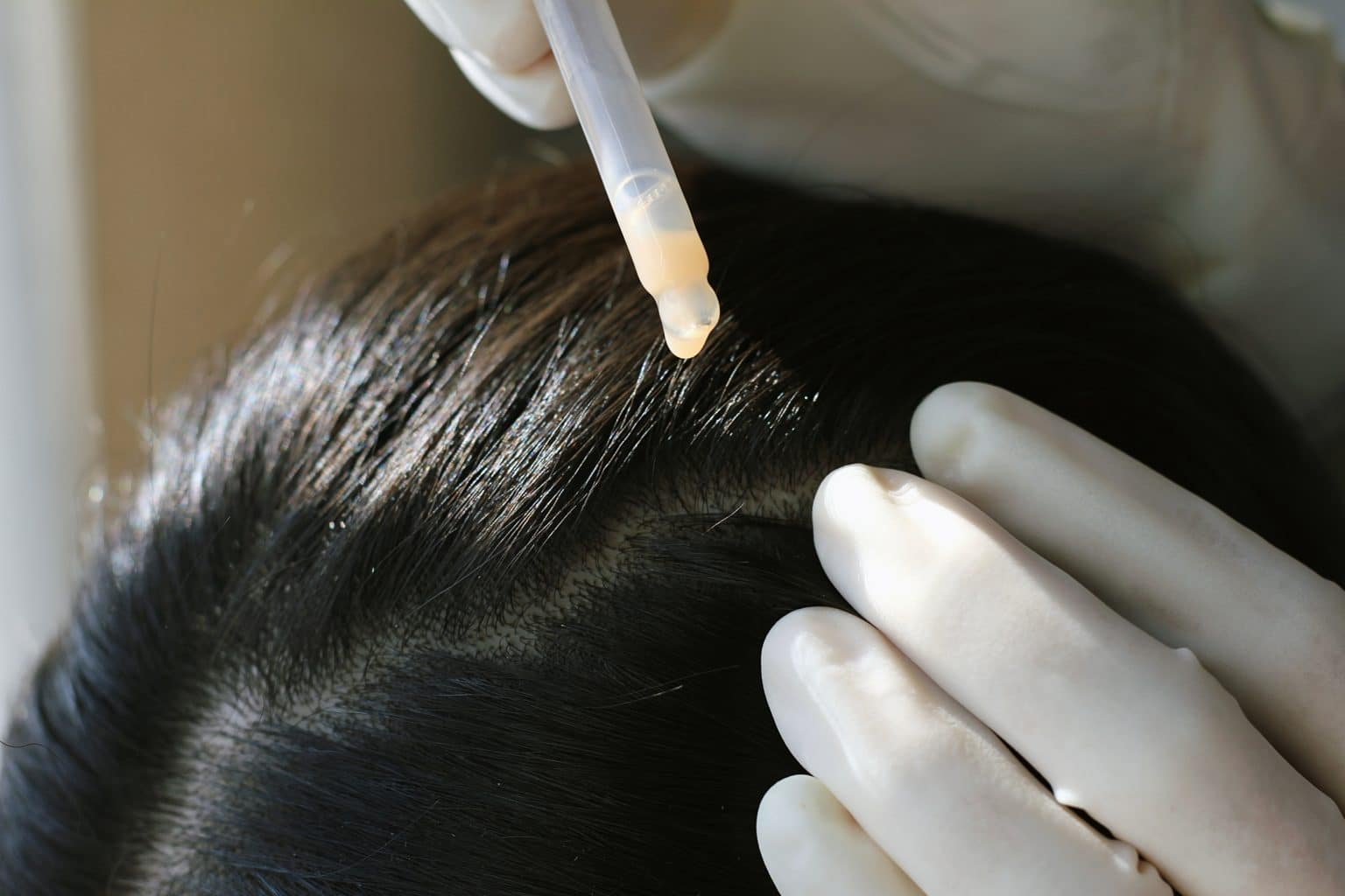Scalp Peel